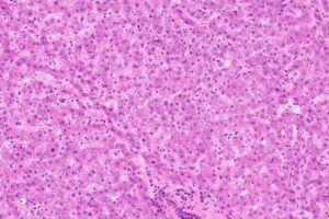 Study explores cost of childhood chemotherapy